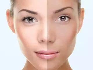 比如如果是皮肤中黑色素过度的堆积会造成脸色发黄,如果是皮肤表层老
