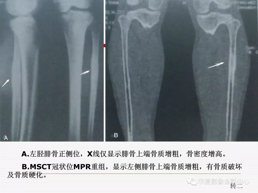 骨髓炎的影像学表现