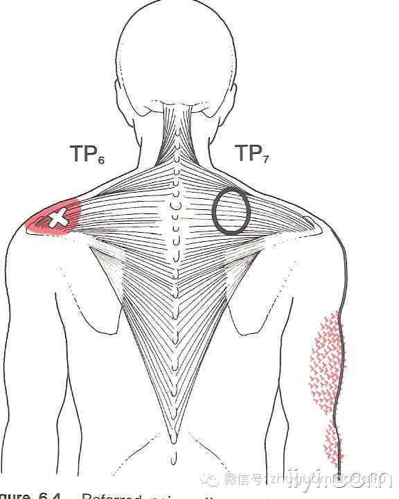 肌筋膜触发点图解多图慎入转载