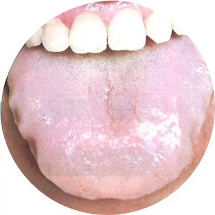 二,阳虚体质典型舌象  1 胖嫩舌,质淡白 舌质:淡白 舌体:胖嫩 舌苔
