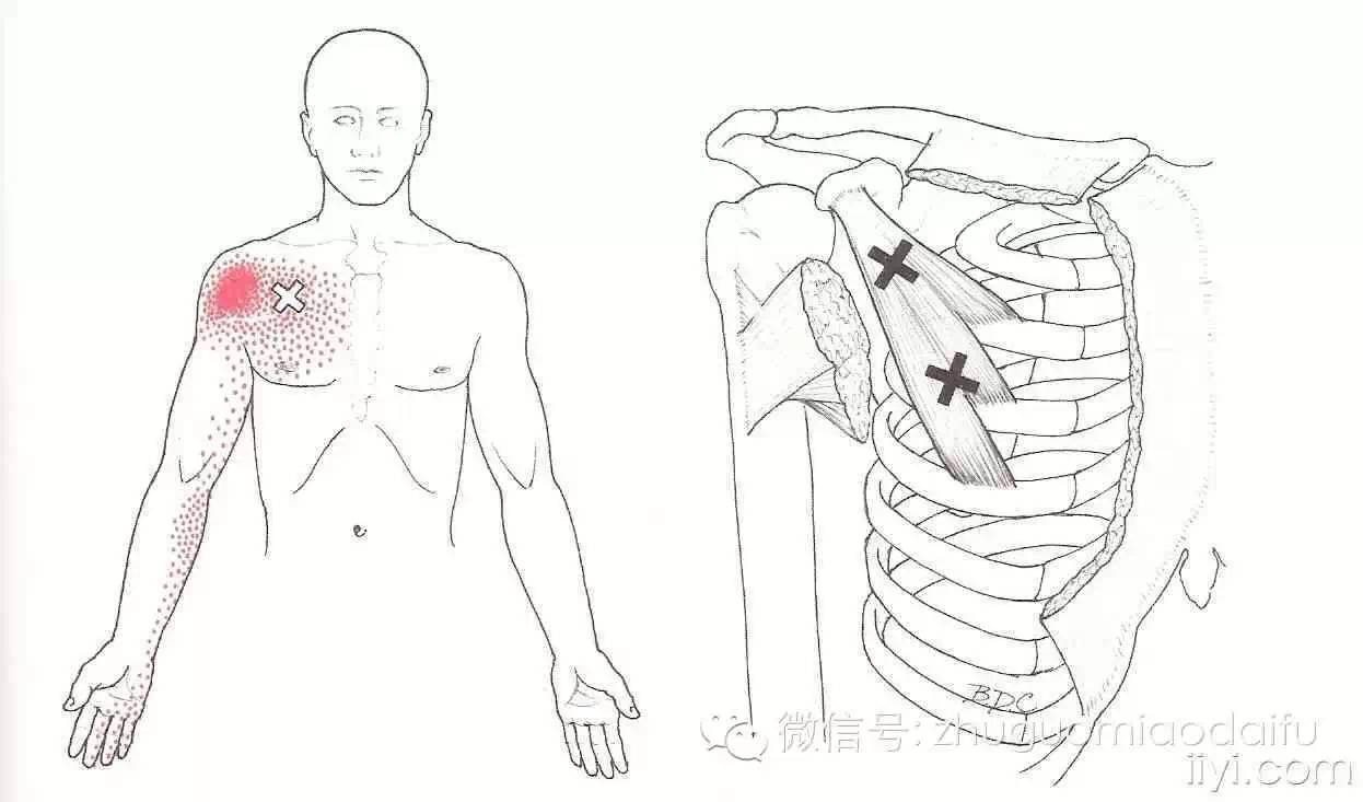 肌筋膜触发点图解(多图,慎入) (转载)