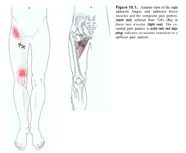 大腿内侧疼痛的肌筋膜激痛点松解治疗 (原创)