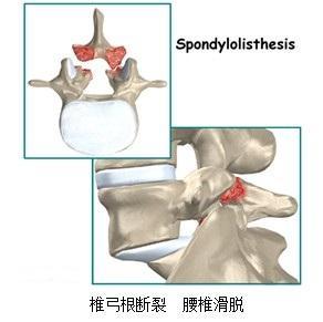 腰椎峡部裂是因外伤或先天性因素导致椎弓峡部骨质不连.