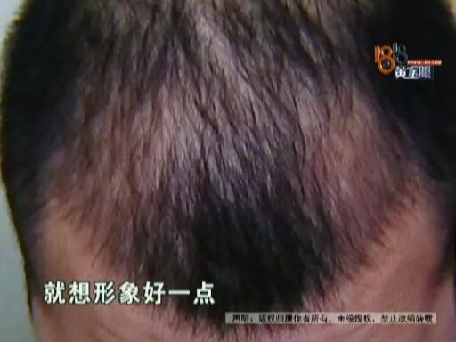 台州27岁小伙脱发严重,贷款4万去植发,低头一