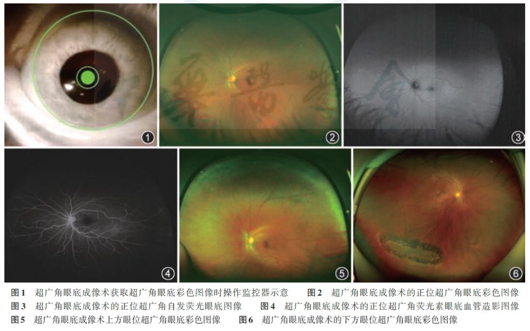 超广角眼底成像术检查图像(图片来自《我国超广角眼底成像术的操作