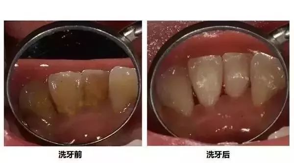 牙结石去掉前后的对比图