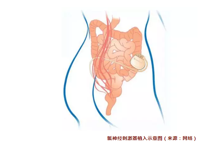 叻罗湖医院开展深圳首例神经源性膀胱骶神经调节术