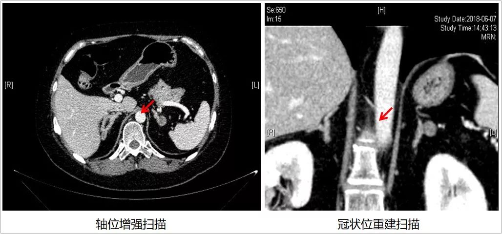 高血压-不育-肾上腺占位迷局,如何破解?