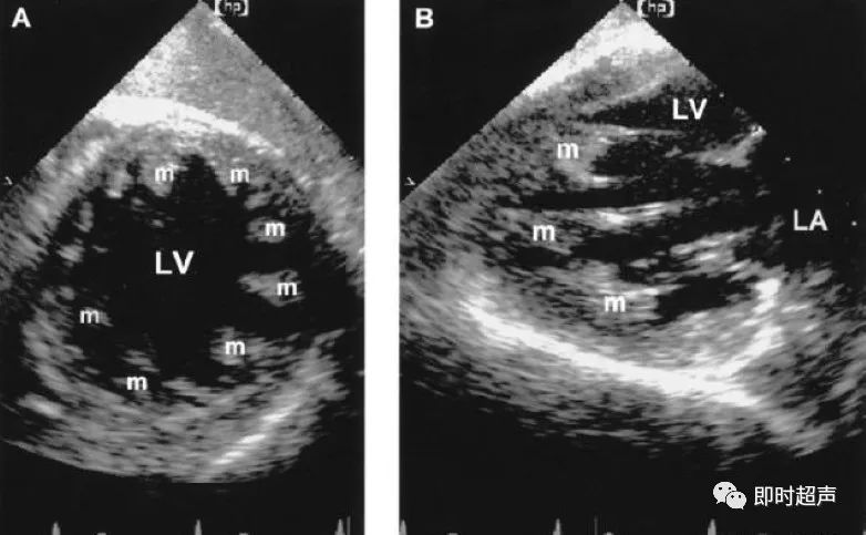 先天性双孔二尖瓣畸形(domv)的超声特点