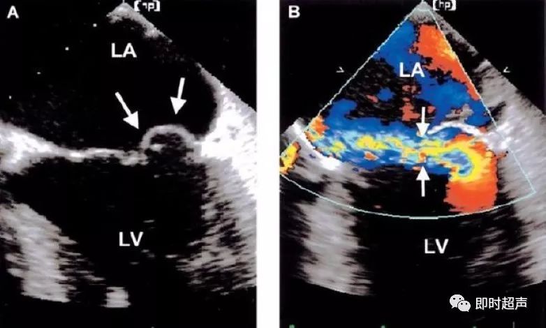 经食道超声显示前内侧瓣口的连枷后叶(箭头示)致二尖瓣偏心返流.