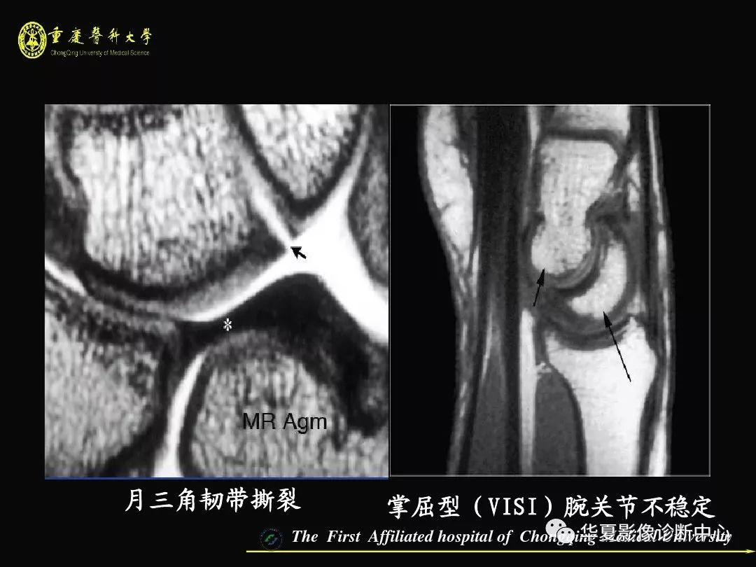 【影像基础】腕关节损伤mri