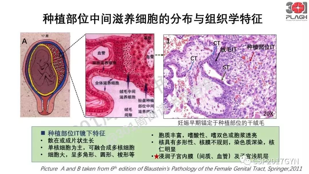 中间型滋养细胞肿瘤的诊断及鉴别诊断