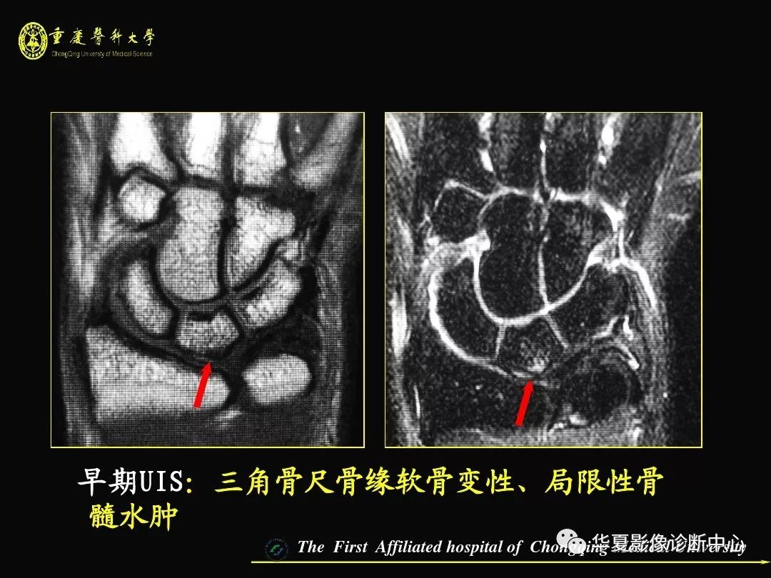 【影像基础】腕关节损伤mri