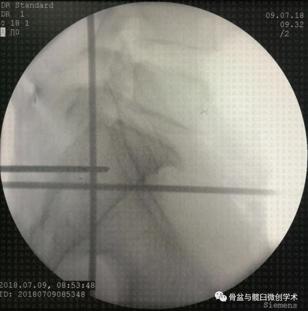 ota61c13型骨盆骨折合并ota62b31型髋臼骨折的微创治疗骶髂螺钉前柱