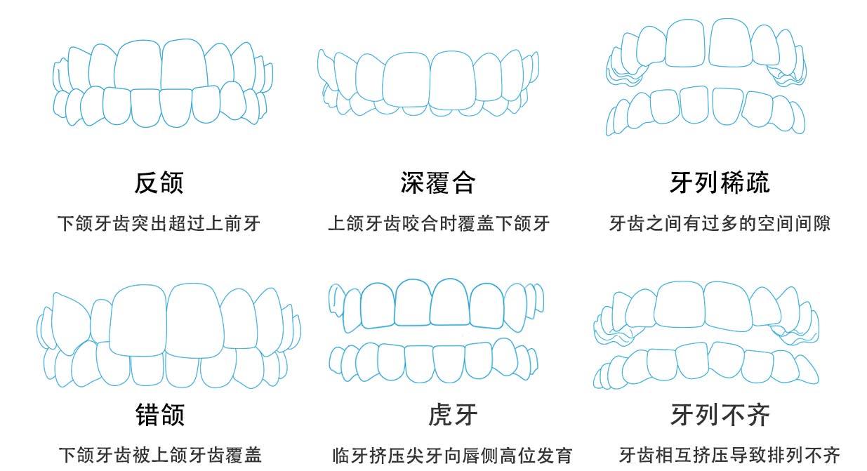 牙齿拥挤患者:表现为牙齿里出外进,不美观,不易清洁,易患龋齿,易形成