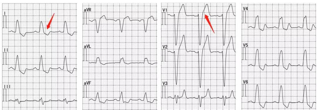 继发性stt改变的心电图及报告解读
