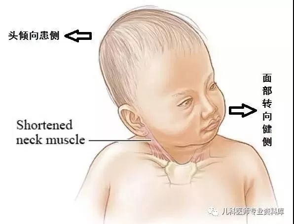 因此耽误了孩子的治疗 小儿肌性斜颈越早治疗效果越理想 所以家长尽早