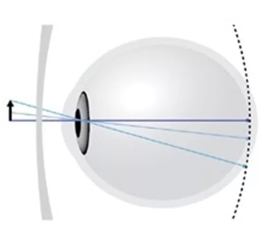 但其外围都投影在视网膜后方,这种现象叫做 视网膜周边远视性离焦