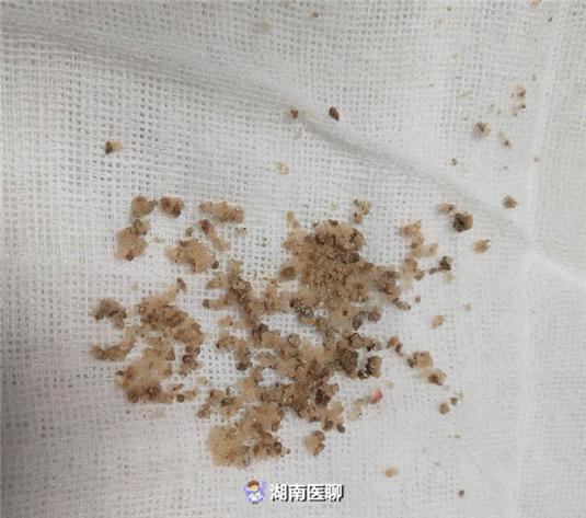 男童膀胱结石反复尿频尿痛还血尿,医生"激光"碎石一次