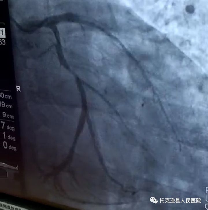 冠脉造影检查提示,心脏有两个血管高度狭窄,还有一个血管闭塞,需要
