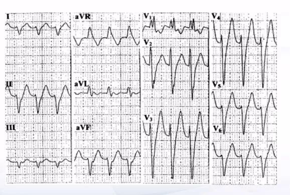 掌握心电图,其实有妙招:孙雅逊老师教你「看图说话!