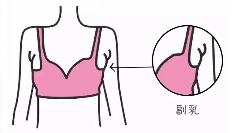 副乳就是腋下的两坨赘肉?你可能被骗了_乳腺