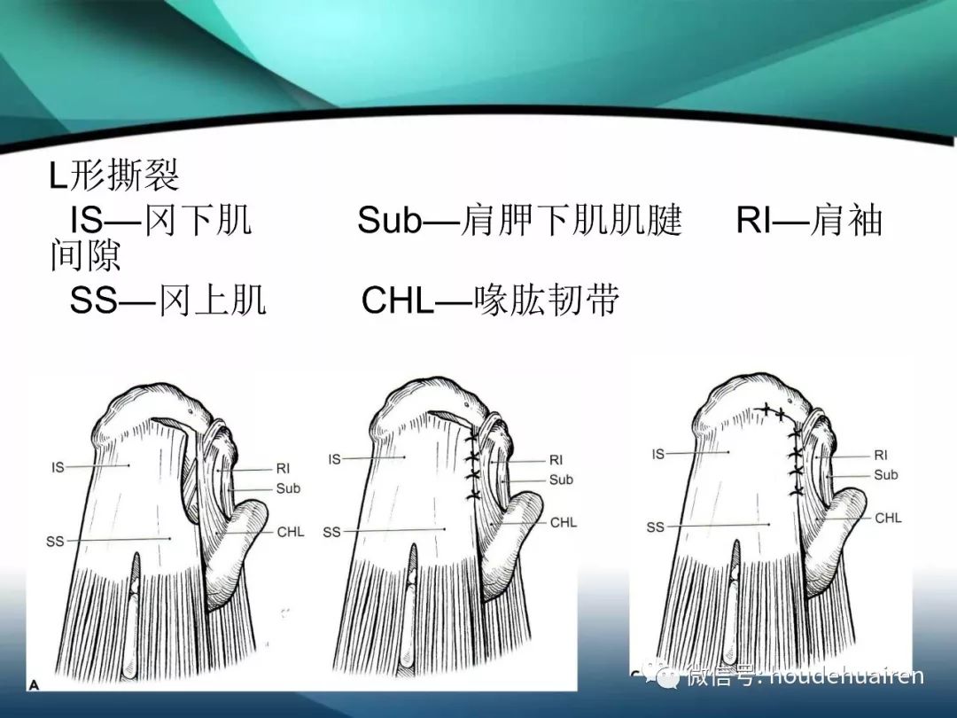 肩袖撕裂的诊断及治疗方法看这篇就够了