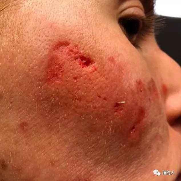 一开始,瑞秋脸上出现红色肿块,看起来像是长了粉刺的皮疹.
