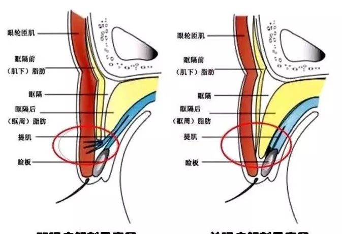 眼部专题 | 眼睑的组织结构与重睑术