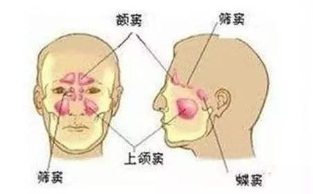 眼球也因此向下移位;急性筛窦炎时,局部症状大多不明显