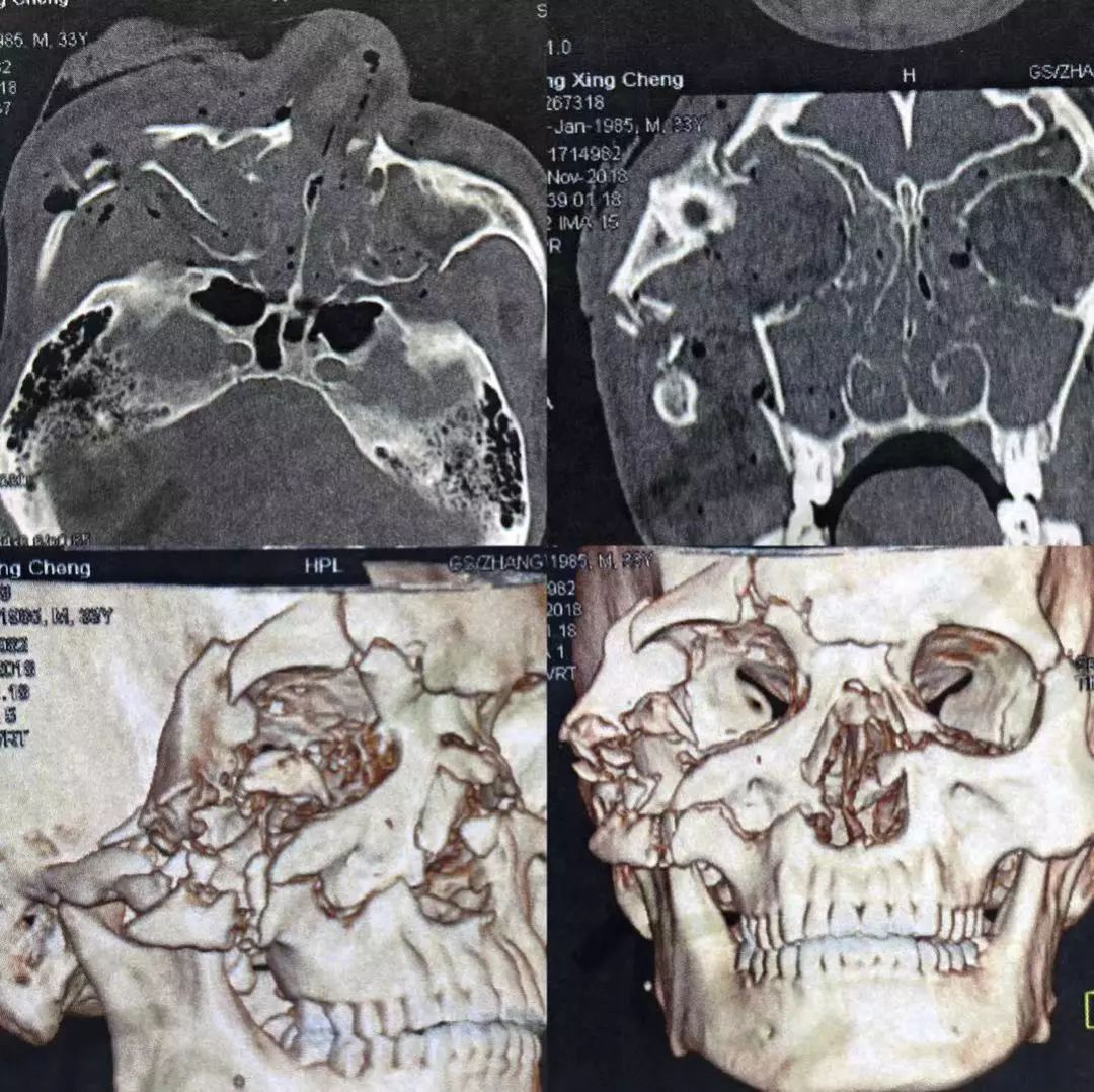 眼科病例分析:严重眶面部骨折手术