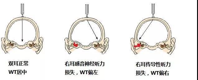 林纳试验 ( rinne test, rt )韦伯试验 ( weber test, wt )2.