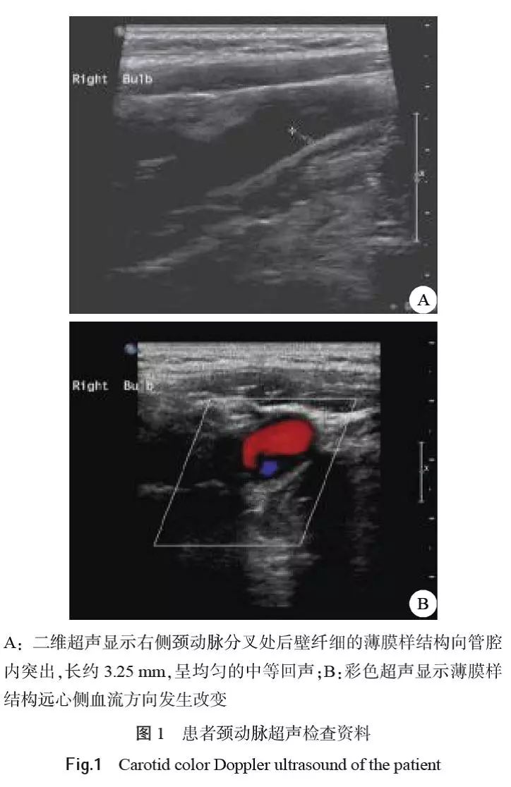 脑梗死伴发颈动脉蹼一例