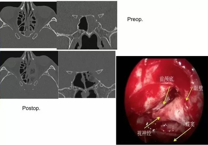 手术视频| 同仁医院康军: 内镜经鼻入路眶视神经管区病变的手术治疗