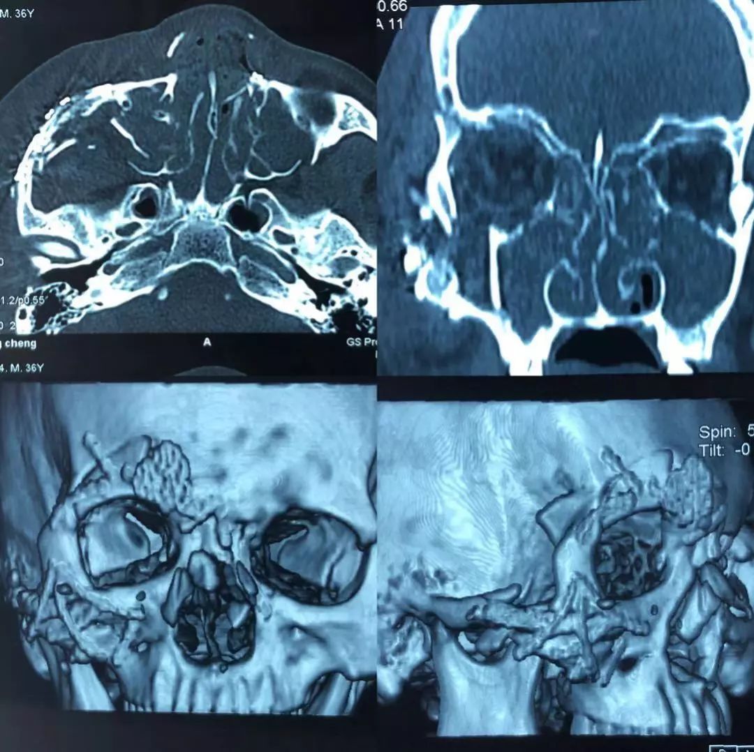 入院后一周在全麻下行双侧眼眶骨折修复术,术中见眶组织去周边组织