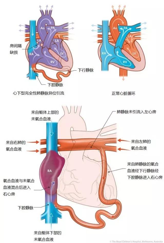 产科疑难超声病例(424):完全性肺静脉异位引流(心内型