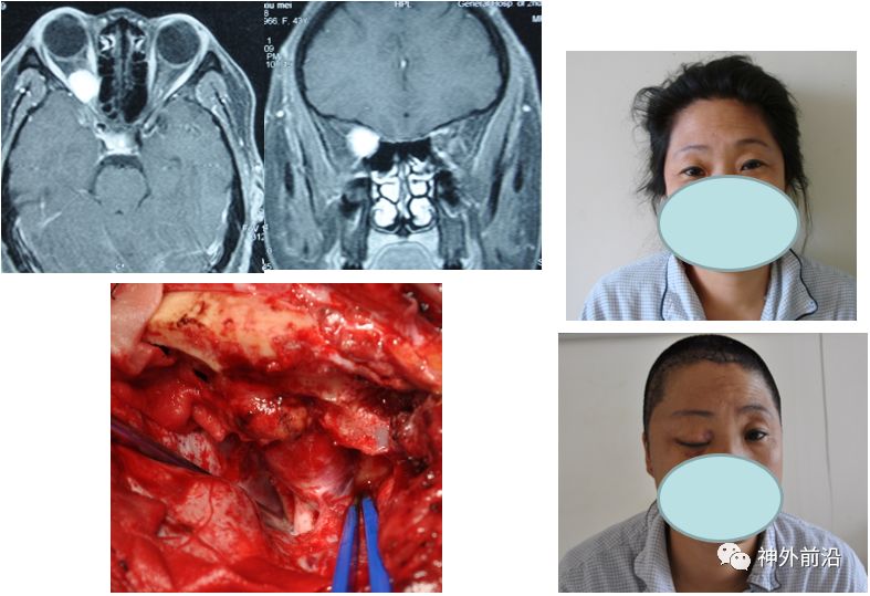 既往传统的手术方式采用右额颞入路,显露视神经管,眶上裂,切除肿瘤.