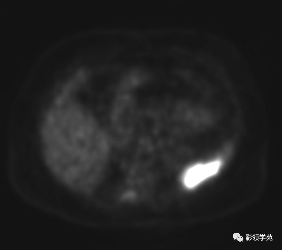 绝经后阴道不规则出血.体格检查和实验室分析均在正常范围内.