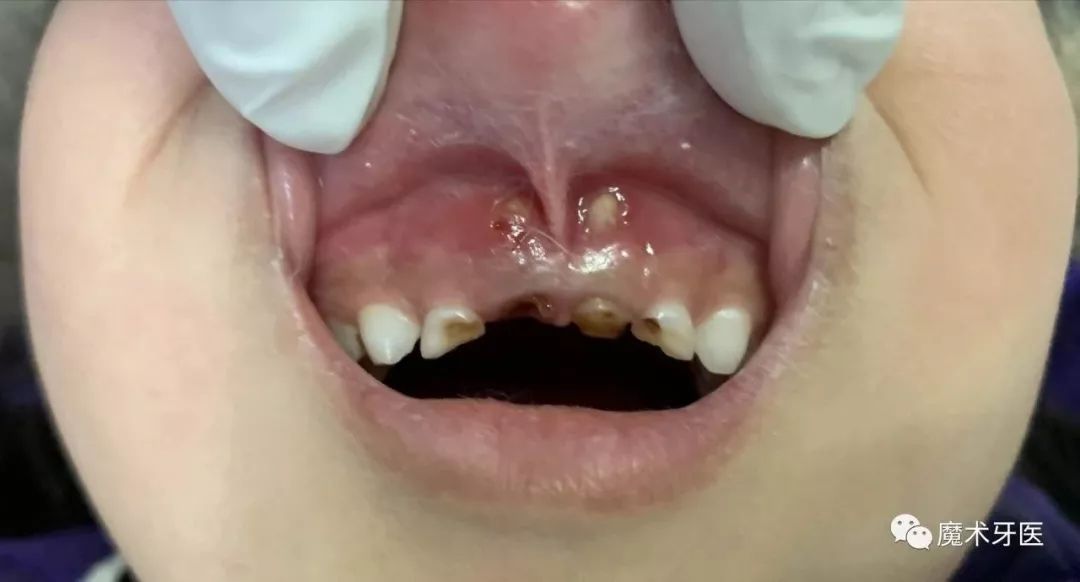 乳牙根尖周炎破坏牙槽骨并穿破粘膜