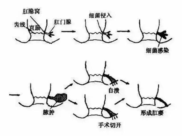 肛窦炎的症状