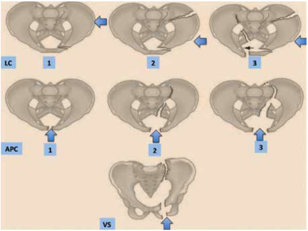 图2. young-burgess骨盆骨折分型