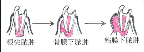 牙根脓肿怎么办