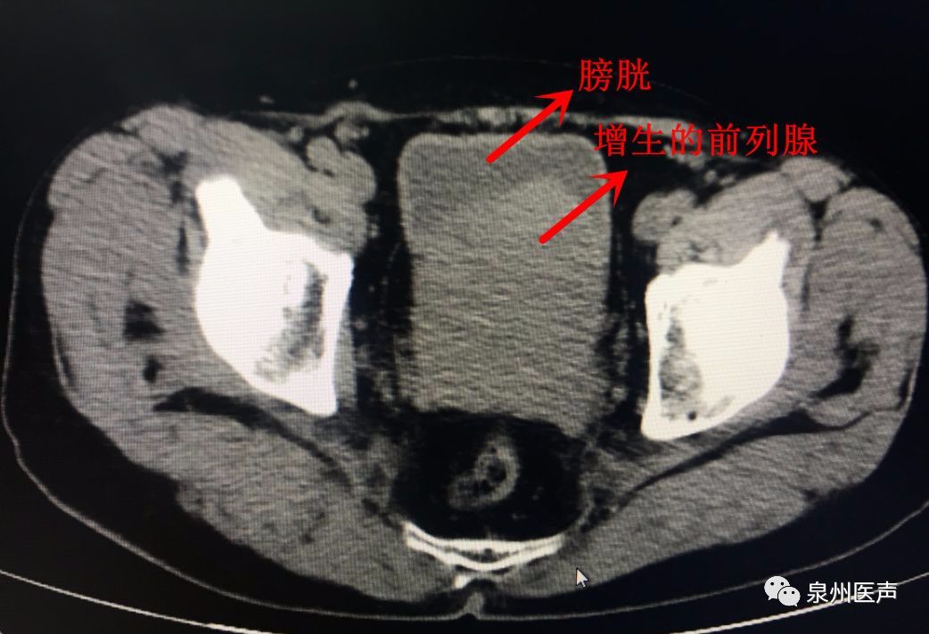 前列腺ct