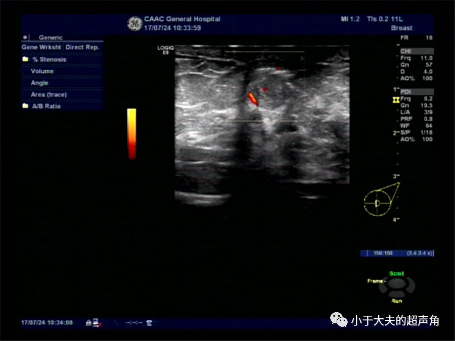 确诊病例小黑板016 | 乳腺导管内乳头状瘤