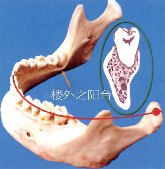 图4 舌侧骨板较薄图5 下颌阻生智齿断根移位于咽峡前间隙的案例及处理