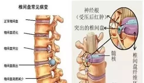 颈腰椎病难见好?不吃药,不手术 ,简单一贴除困扰,试过