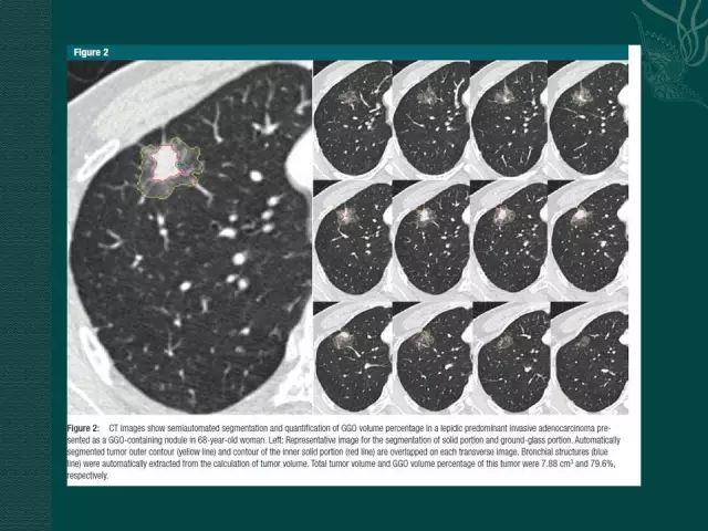 肺癌egfr突变影像学特点一文读懂