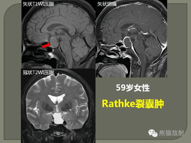 垂体柄解剖及病变影像表现