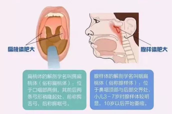 扁桃体,腺样体傻傻分不清楚?看完本文你就明白了!