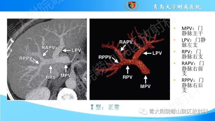 门静脉解剖,变异及常见病变影像表现